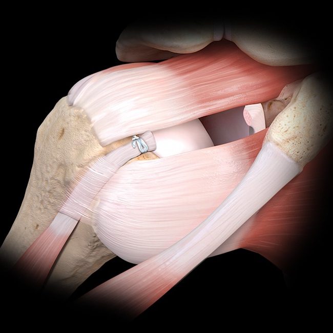 loop_n_tack_knotless_biceps_teno